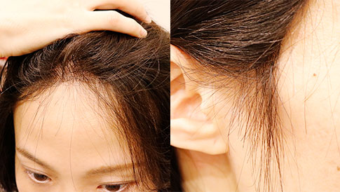 髪を上げたおでこの生え際 つむじのアップ